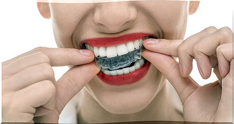 Woman who puts in a mouthguard because she suffers from bruxism